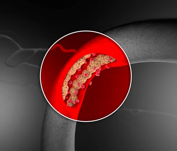 Tvorba Cholesterolu Tuk Tepna Žíla Srdce Červené Krvinky Průtok Krve — Stock fotografie