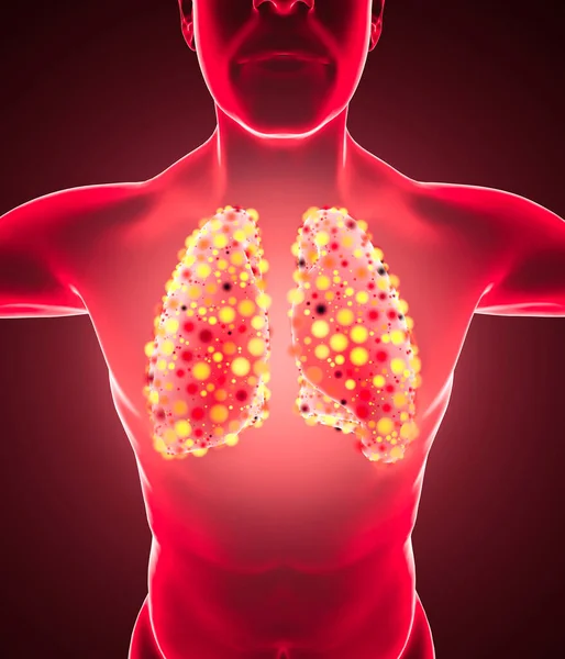 人間の解剖学 呼吸器系の問題 重度の損傷を受けた肺 二国間肺炎 Covid コロナウイルス 患者と煙 喫煙者だ 3Dレンダリング — ストック写真