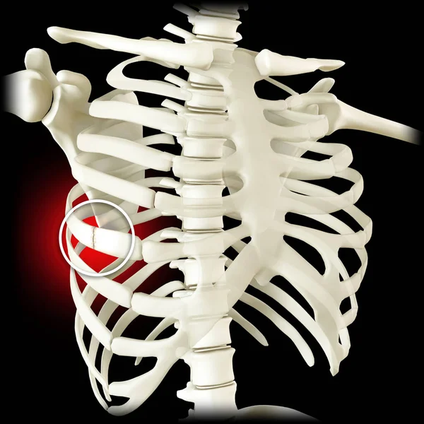 Anatomie Het Menselijk Lichaam Costochondrale Scheiding Gescheiden Rib Gebroken Gebroken — Stockfoto