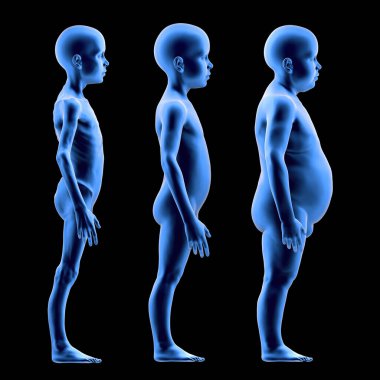 Karşılaştırıldığında yetersiz beslenmiş, normal yapılı ve obez bir çocuk. Çocuklarda gıda kıtlığı ve obezite sorunları var. 3d hazırlayıcı 