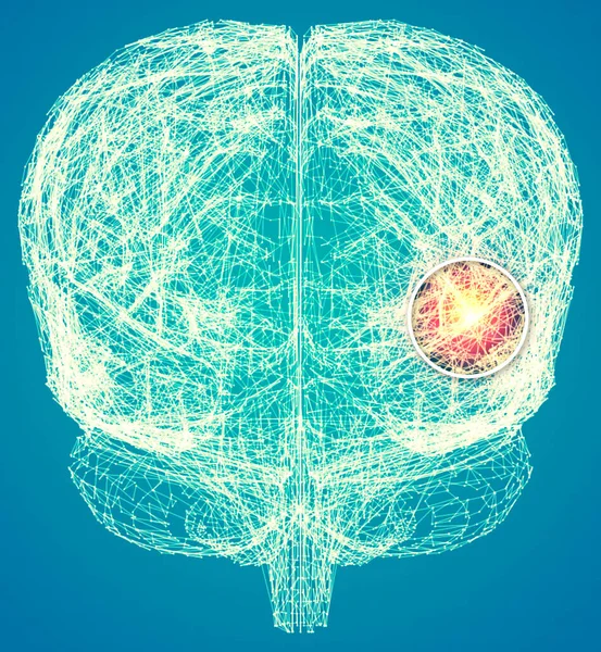 Memory lapses, forgetting things, degenerative disease. Brain problems. Parkinson and alzheimer desease. Mental health. Stroke, synapses and neurnons interaction. 3d render