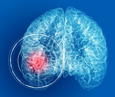 Baş ağrısı, beyin ve sinapslar, bilişsel sorunlar, zihinsel bozukluklar. Anevrizma. Beyin bölgesini etkileyen dejeneratif hastalıklar. Parkinson ve Alzheimer. 3 boyutlu görüntüleme. Vuruş