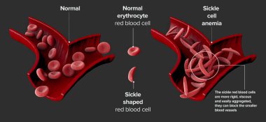 Orak hücre hastalığı bir grup kan bozukluğudur. Orak hücre anemisi. Alyuvar hücrelerinde bulunan oksijen taşıyan protein hemoglobininde anormalliğe neden olur. 3d hazırlayıcı