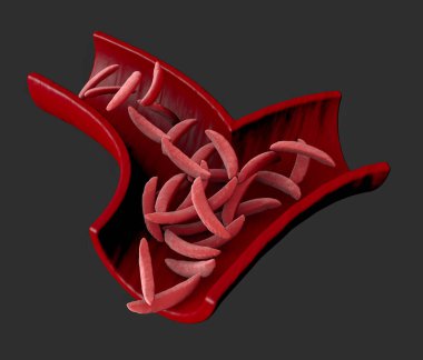 Orak hücre hastalığı bir grup kan bozukluğudur. Orak hücre anemisi. Alyuvar hücrelerinde bulunan oksijen taşıyan protein hemoglobininde anormalliğe neden olur. 3d hazırlayıcı