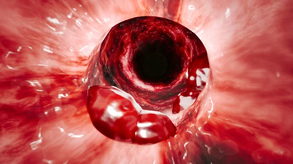 肠壁的内视 结直肠癌 Crc 结肠癌或直肠癌 侵入或扩散到身体其他部位的细胞的异常生长 3D渲染 — 图库照片