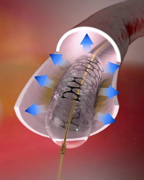 Veia e sangue e um stent — Fotografia de Stock