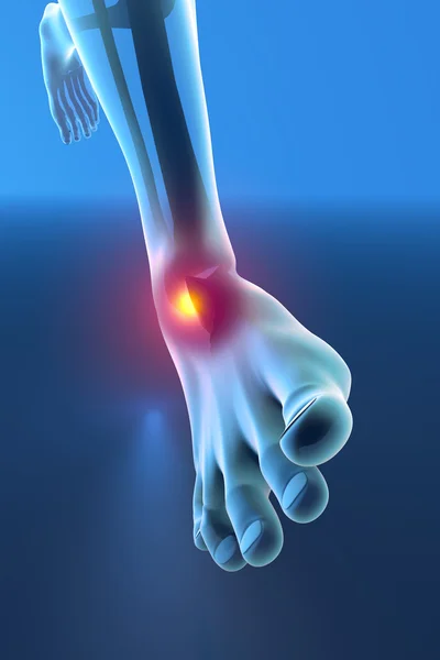 Sprained ankle blue x-ray — Stock Photo, Image