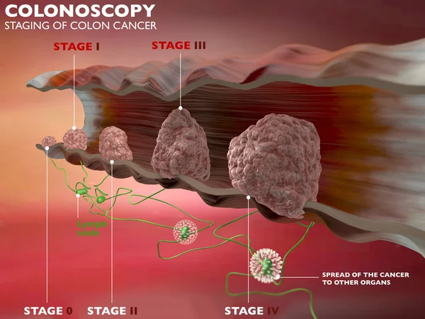 Stages of colon cancer — Stock Photo, Image