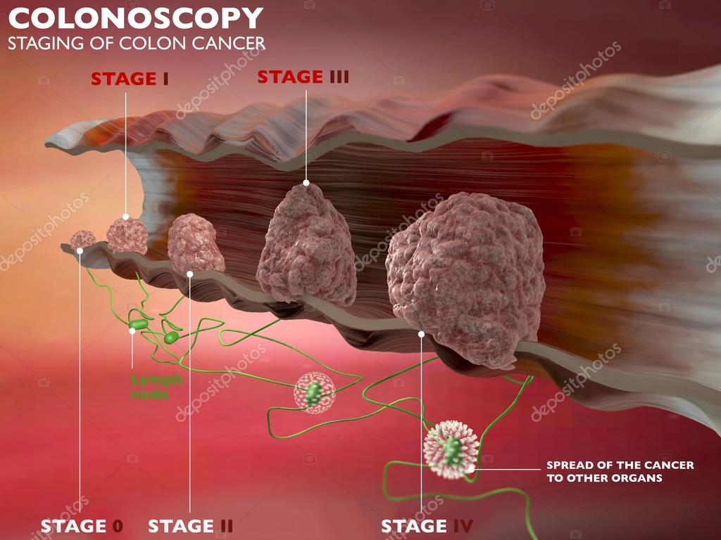 Рак кишечника метастазы прогноз. Стадии злокачественных новообразований. Стадии злокачественной опухоли. Метастазы злокачественных опухолей.