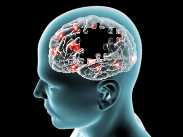 Дегенеративные заболевания мозга Паркинсон — стоковое фото