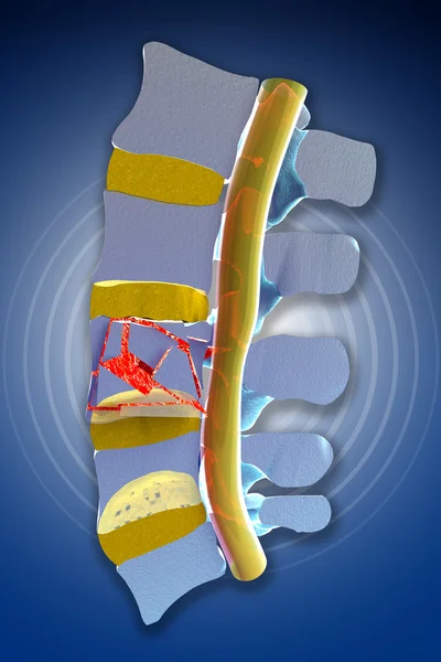Spina, midollo, fratture traumatiche vertebrali — Foto Stock