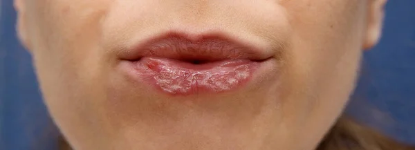 Vrouwen Onaantrekkelijke Onaantrekkelijke Lippen Met Peeling Wonden Hik Hoeken — Stockfoto