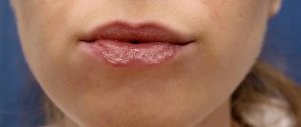 Vrouwen Onaantrekkelijke Onaantrekkelijke Lippen Met Peeling Wonden Hik Hoeken — Stockfoto