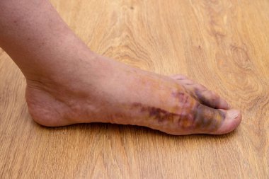 Bacağa ağır bir cisim düştüğünde sol ayağında hematoma olan şişmiş erkek bacağı.