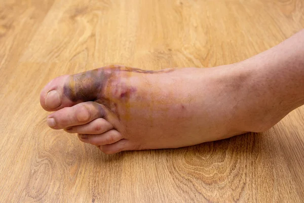 Swollen Injured Male Limb Left Foot Hematoma Heavy Object Falls — Stock Photo, Image
