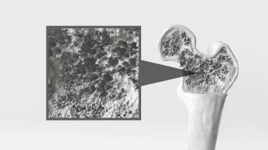 Osteoporoz 3. aşamanın 2. aşaması - 3 boyutlu oluşturma