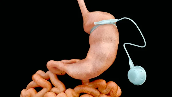 Adjustable Gastric Band - AGB -- 3D Rendering