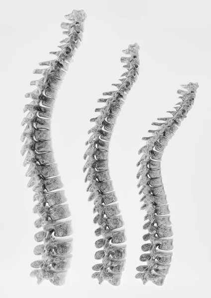 Etapas Curvatura Osteoporosis Columna Vertebral Renderizado — Foto de Stock