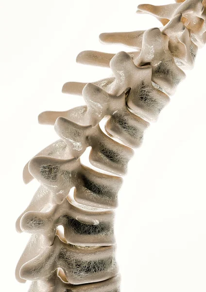 Osteoporosis Curvature Stages Spine Rendering — Stock Photo, Image