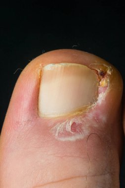 İnsan ayak tırnağı enfeksiyonunun yakın plan fotoğrafı.