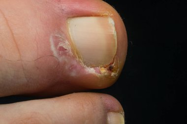 İnsan ayak tırnağı enfeksiyonunun yakın plan fotoğrafı.