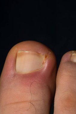İnsan ayak tırnağı enfeksiyonunun yakın plan fotoğrafı.
