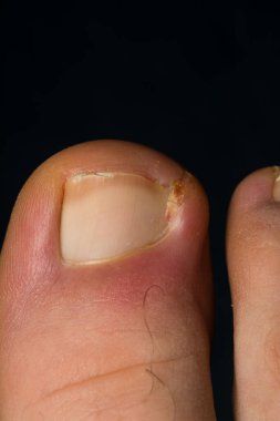 İnsan ayak tırnağı enfeksiyonunun yakın plan fotoğrafı.