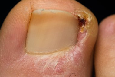 İnsan ayak tırnağı enfeksiyonunun yakın plan fotoğrafı.