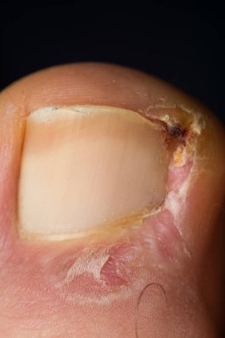İnsan ayak tırnağı enfeksiyonunun yakın plan fotoğrafı.
