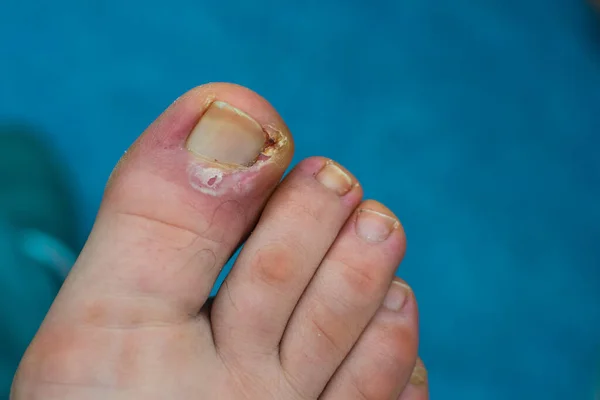 close-up photo of a toenail infection in human