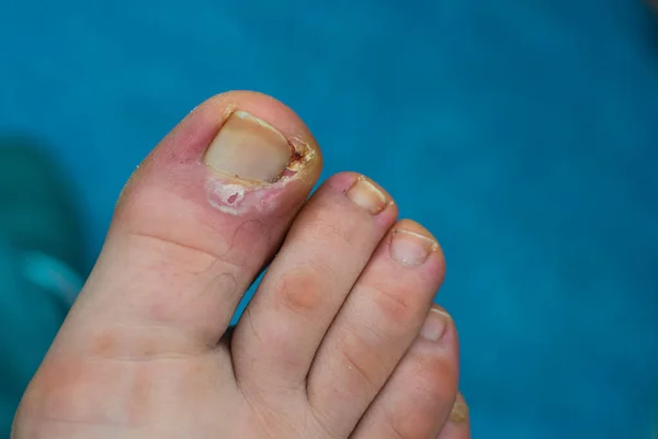 Close Photo Toenail Infection Human — Stock Photo, Image