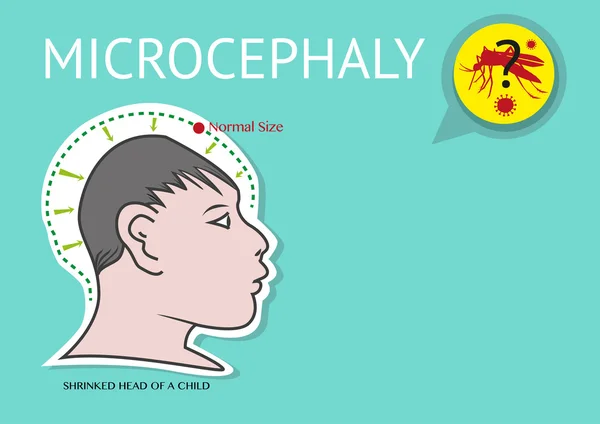 Microcephaly 머리의 비정상적인 소 Zika 바이러스에 링크. — 스톡 벡터