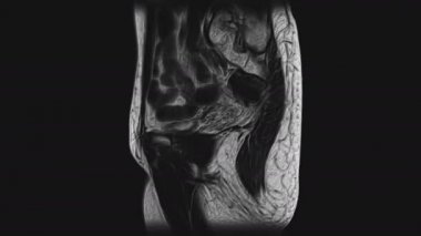 Kadın pelvik organlarının voluminöz MR 'ı, karın boşluğu, gastrointestinal bölge ve mesane.