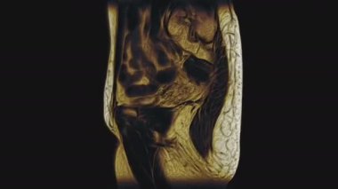 Kadın leğen kemiğinin, karın boşluğunun, gastrointestinal yolun ve mesanenin volinöz renkli MR 'ı.