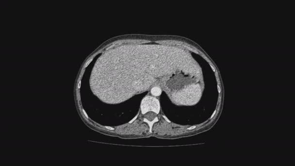 Kadın pelvik organlarının voluminöz MR 'ı, karın boşluğu, gastrointestinal bölge ve mesane. — Stok video