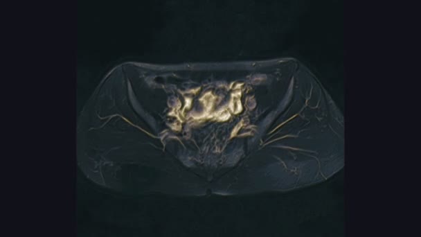 Női medencei szervek, hasüreg, gyomor-bélrendszer és húgyhólyag térfogatos MRI-je — Stock videók