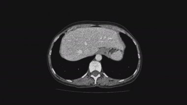 Kadın pelvik organlarının voluminöz MR 'ı, karın boşluğu, gastrointestinal bölge ve mesane.