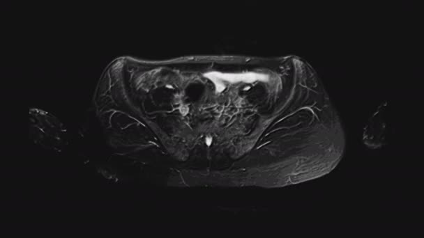 Έντονος χρωματικός MRI γυναικείων πυελικών οργάνων, κοιλιακής κοιλότητας, γαστρεντερικού σωλήνα και ουροδόχου κύστης — Αρχείο Βίντεο