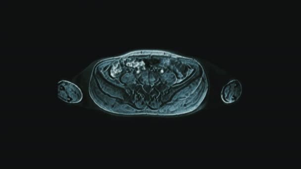 メス骨盤器官、腹腔、消化管、膀胱のボリュームカラーMRI — ストック動画