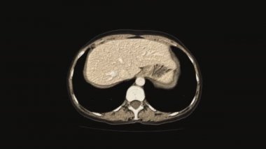 Kadın leğen kemiğinin, karın boşluğunun, gastrointestinal yolun ve mesanenin volinöz renkli MR 'ı.