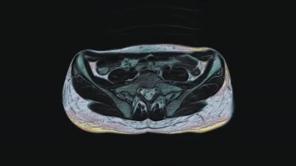 Sebagian besar diwarnai MRI dari organ panggul perempuan, rongga perut, saluran pencernaan dan kandung kemih — Stok Video