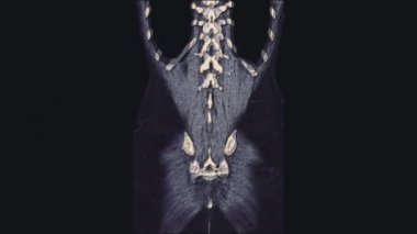 Kadın leğen kemiğinin, karın boşluğunun, gastrointestinal yolun ve mesanenin volinöz renkli MR 'ı.