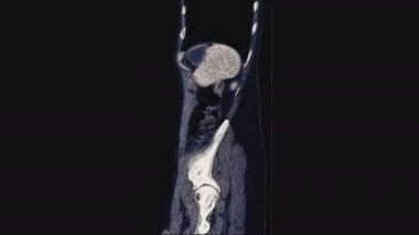 Kadın leğen kemiğinin, karın boşluğunun, gastrointestinal yolun ve mesanenin volinöz renkli MR 'ı.