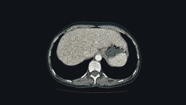 МРТ женских тазовых органов, брюшной полости, желудочно-кишечного тракта и мочевого пузыря — стоковое видео