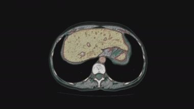 Kadın pelvis organlarının, karın boşluğunun, bağırsak yolunun ve mesanenin çok renkli MR 'ı.