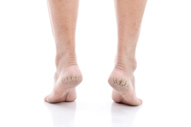 Topuklardaki çatlakları izole et 