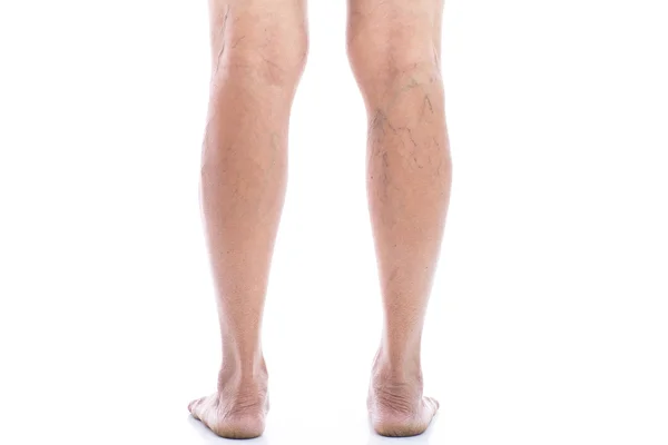 Varicose vein Isolated on white — Stock Photo, Image