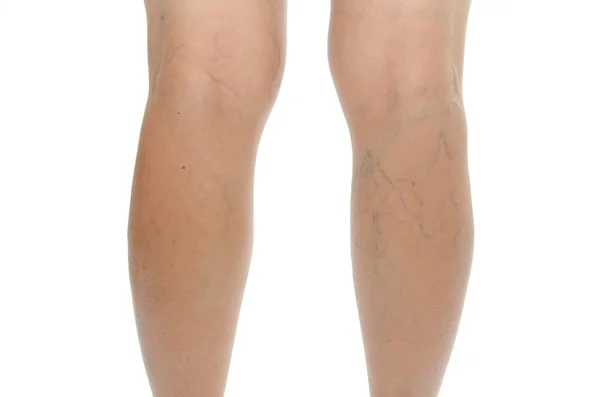 Varicose vein. Isolated — Stock Photo, Image