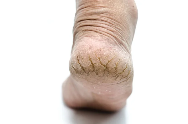 Close up of Cracks on Heels isolated — Stock Photo, Image