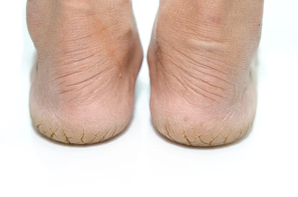 Close up  of Cracks on  Heels — Stock Photo, Image